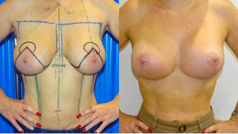 breast lift with implants before and after