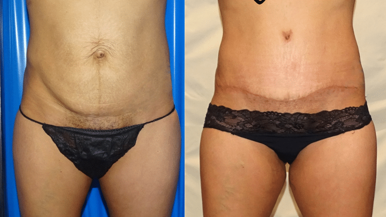 abdominoplasty before after 14