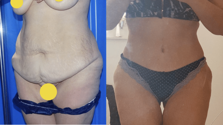 brazilian tummy tuck before after 12