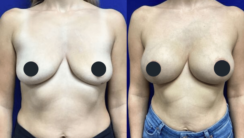 breast lift before after 5