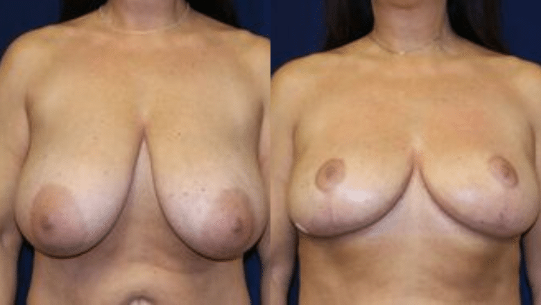 breast lift before after 6
