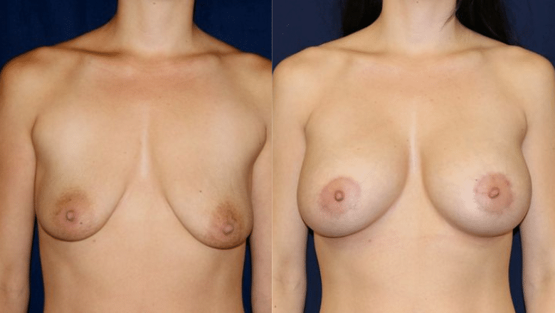 breast lift before after 10