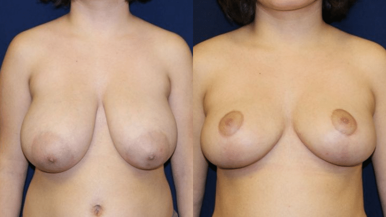 breast reduction before after 6