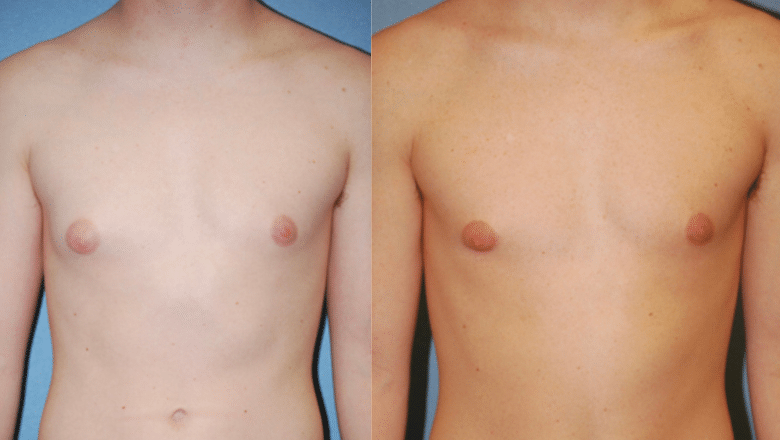 male gyno before after 1
