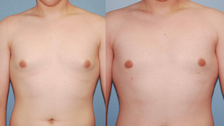 male gyno surgery before after 2