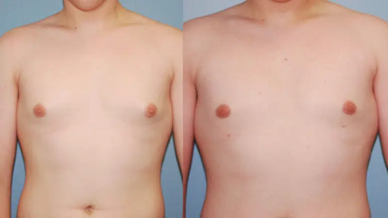 male gyno surgery before after 2