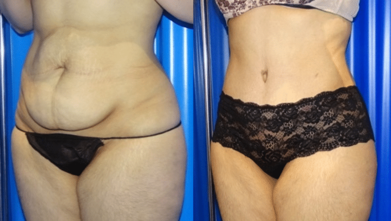 brazilian tummy tuck before after 4