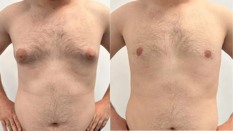 gyno surgery before after frontal view