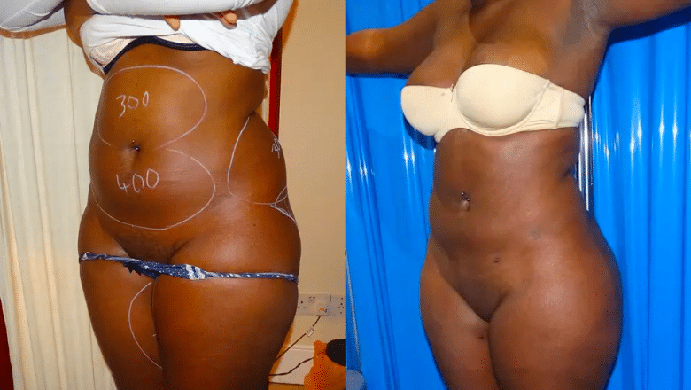 360 liposuction before and after 2