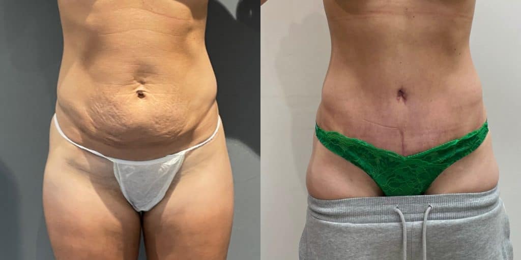 mini tummy tuck before and after