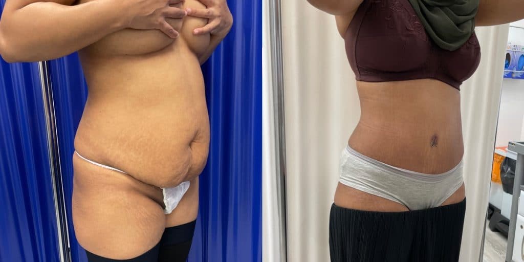 brazilian tummy tuck before and after