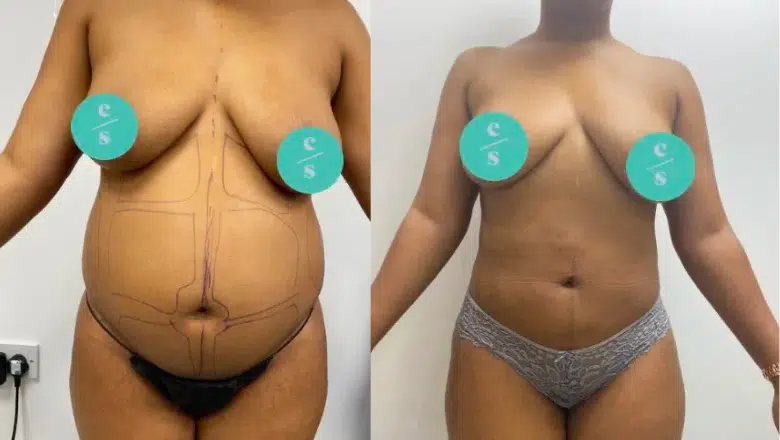 belly liposuction before and after 