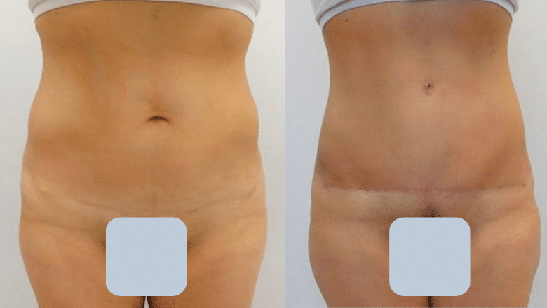 abdominoplasty before after 15
