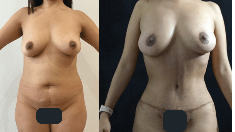 abdominoplasty before after
