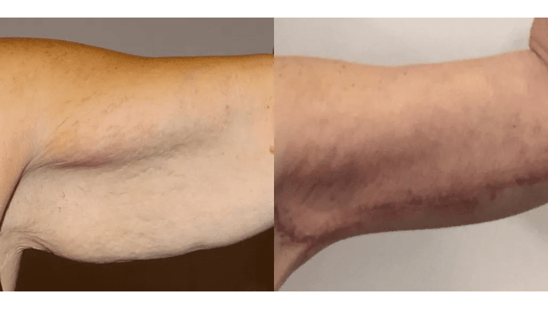arm lift before and after photos