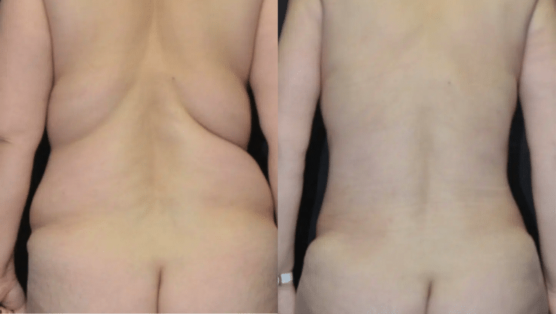 back liposuction before and after 