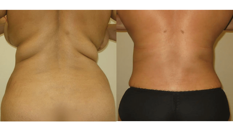 back liposuction before and after 2