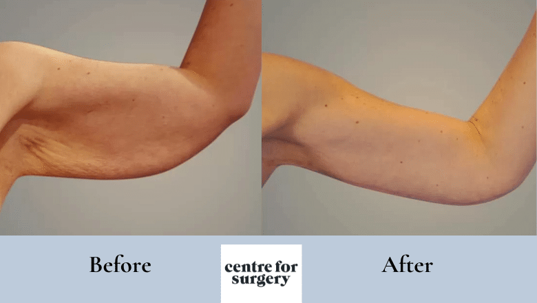 Minimal Incision Arm Lift Boca Raton  Optimization Centre