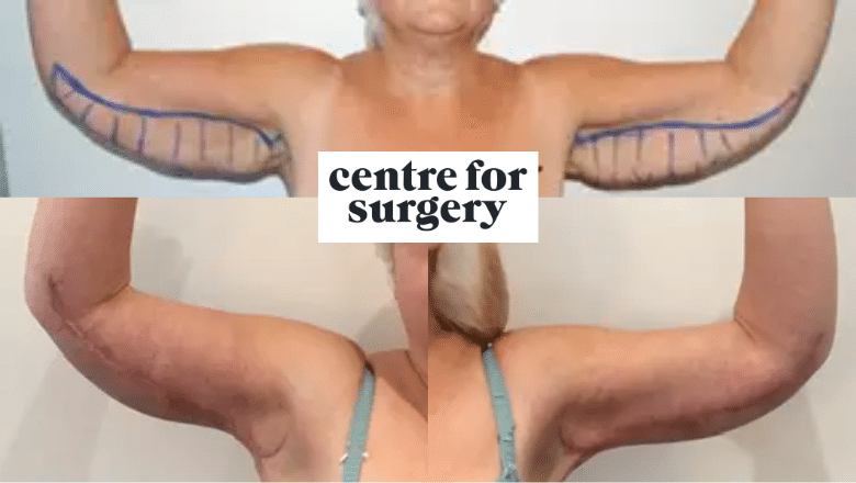 brachioplasty before and after results