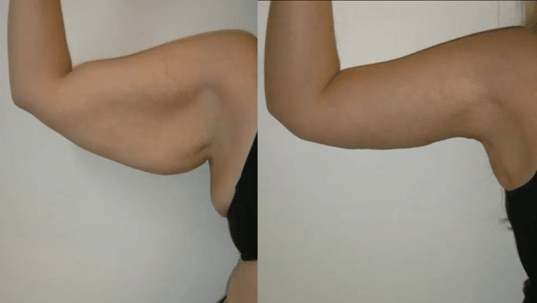 brachioplasty before and after photos