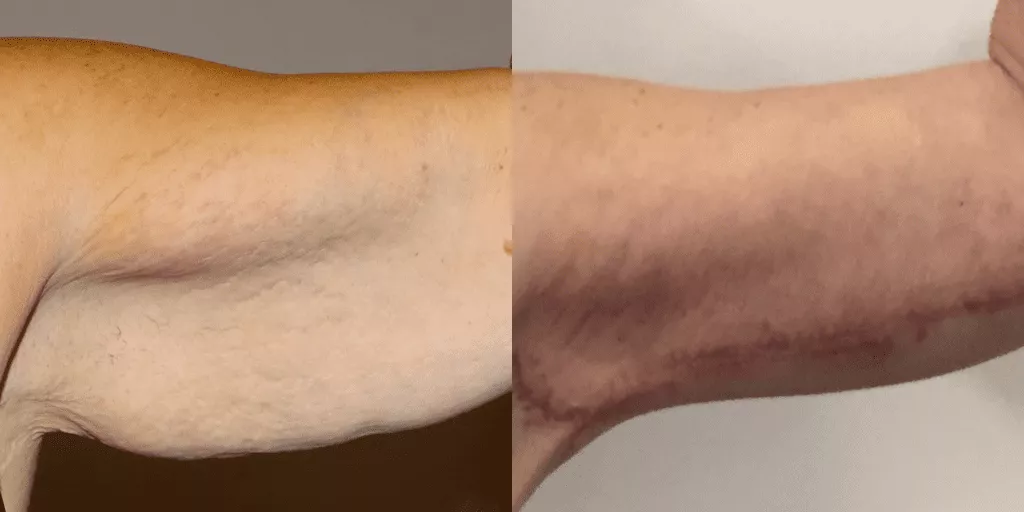brachioplasty before and after