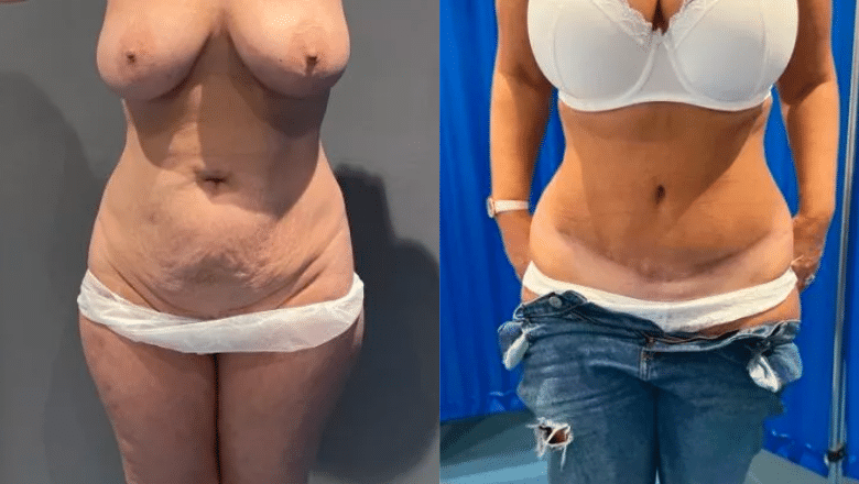 brazilian tummy tuck before and after 1