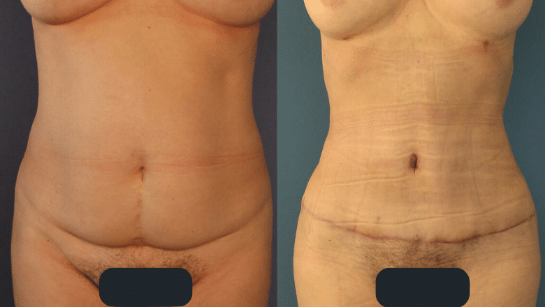 brazilian tummy tuck before and after 3