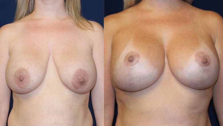 breast lift before after 7