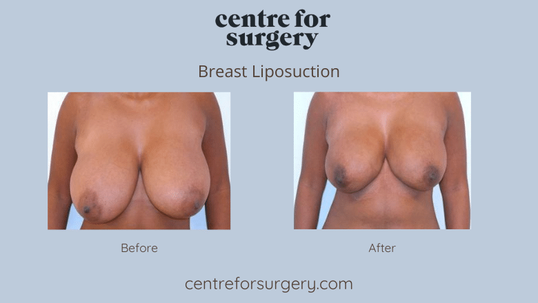 breast liposuction before and after 2