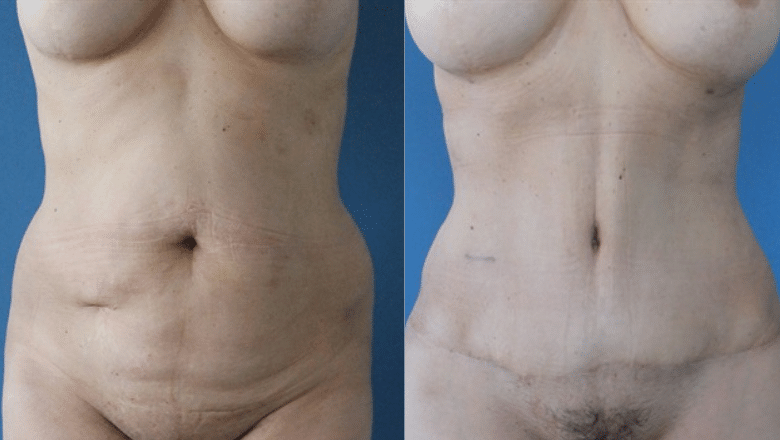 lipoabdominoplasty before and after