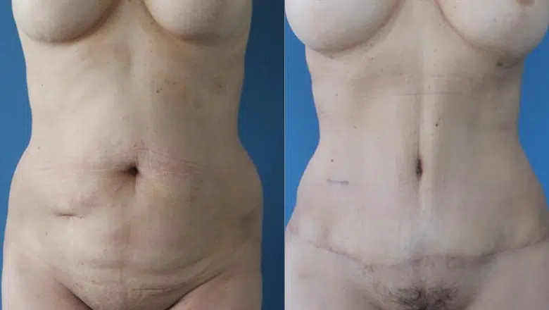 lipoabdominoplasty before and after