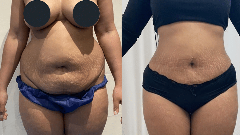 liposuction before after 8
