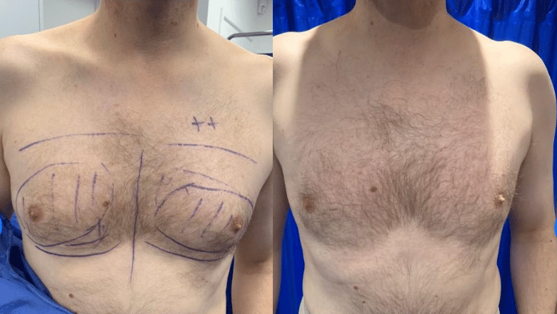 male gyno surgery before and after 8