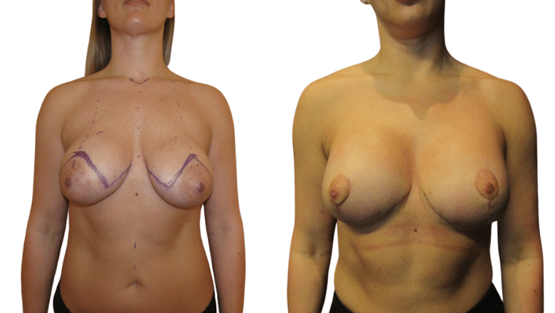 mastopexy before after 2