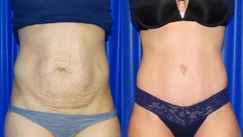 tummy tuck