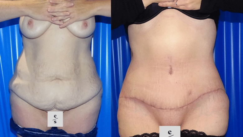 tummy tuck before after 12