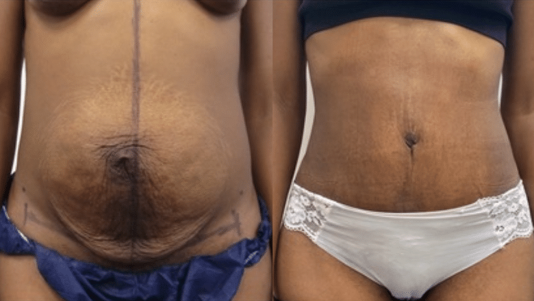 abdominoplasty and muscle repair before after 3