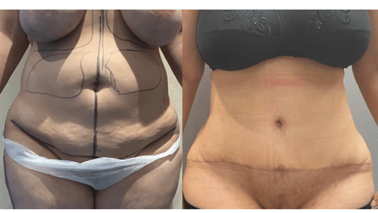 tummy tuck before after 8