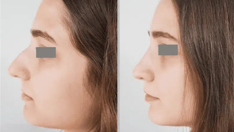 nose bridge rhinoplasty before after