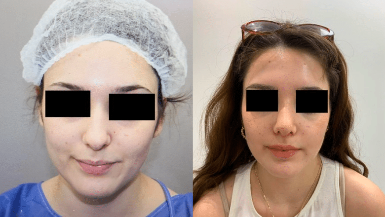 ultrasonic rhinoplasty before and after frontal view