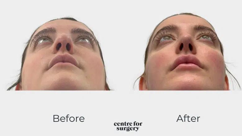 Rhinoplasty London UK