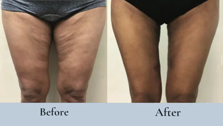 Thigh lift before after 6