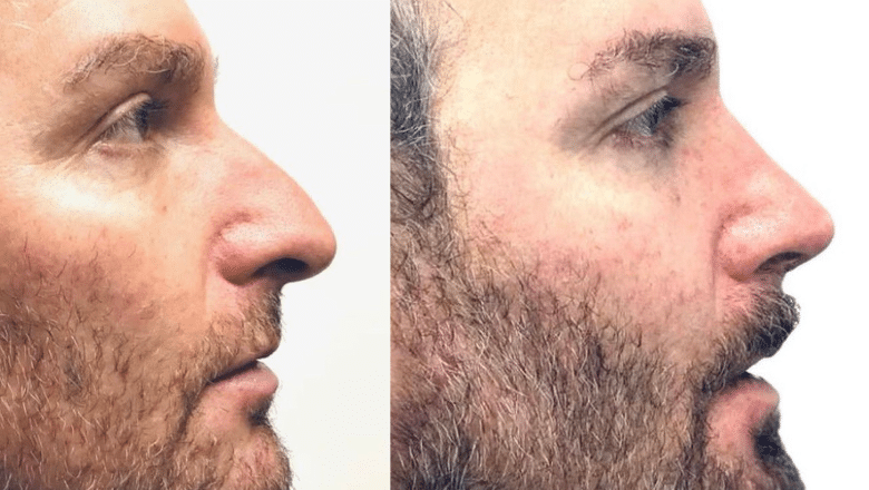 male nose job before after