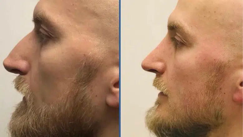 male rhinoplasty before after