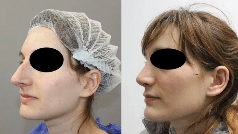 ultrasonic nose surgery before and after