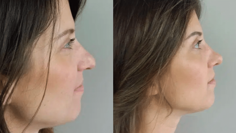 tip plasty before and after
