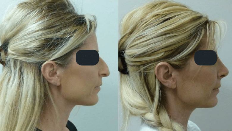 rhinoplasty before and after 7
