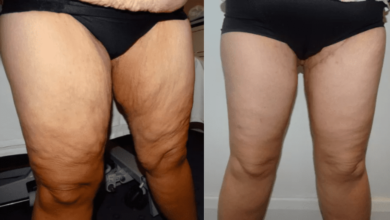 thigh lift before and after photos (1)