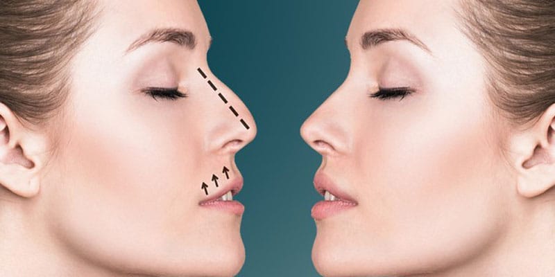 what conditions can rhinoplasty correct