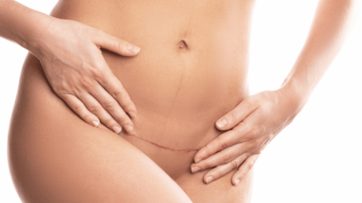 How to Minimise Scars after Tummy Tuck Surgery | Centre for Surgery